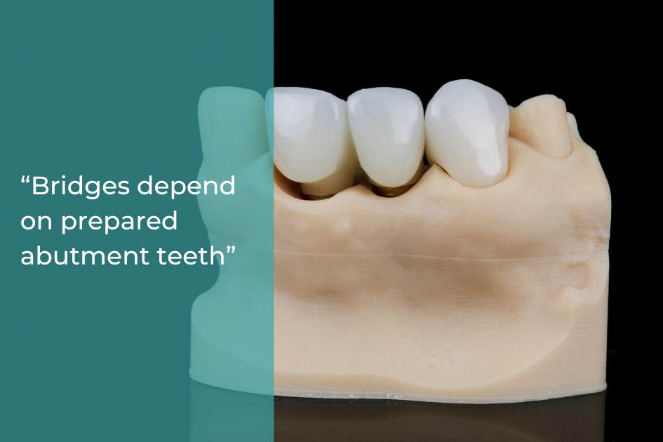 Dental model showing a bridge supported by prepared abutment teeth, highlighting how bridges play an important role in oral health, with the text, “Bridges depend on prepared abutment teeth,” on a teal overlay.