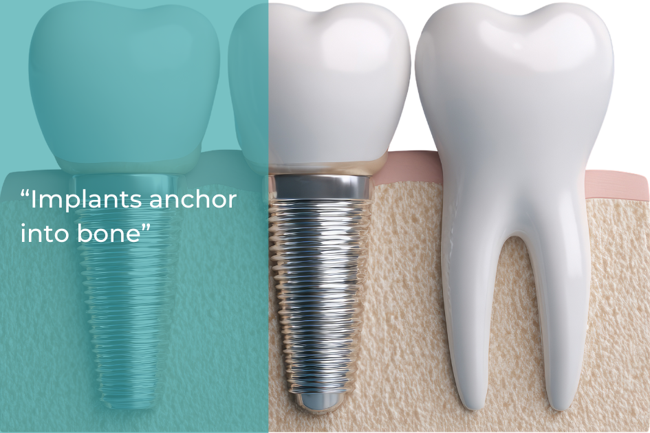 Illustration showing a dental implant anchored in jawbone next to a natural tooth, highlighting how dental implants support oral health more effectively than traditional bridges. Text states, "Implants anchor into bone.